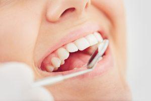 Zahn-Veneers in der Türkei – Strahlendes Lächeln. Für die Behandlung in der Türkei mit Zahn-Veneers sollte man einen Aufenthalt von min 4Tage