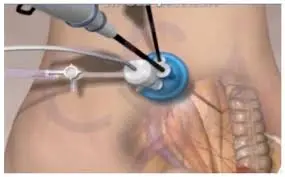 SILS-Methode (Single-Incision Laparoscopic Surgery) Magenverkleinerung ohne Narbe