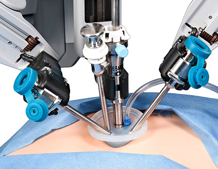 Scarless Gastric Sleeve – Single-Incision Laparoscopic Surgery (SILS)