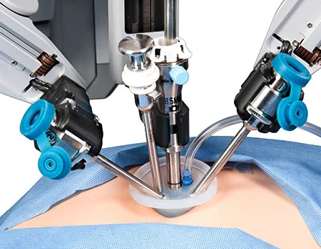 Die SILS-Methode (Single-Incision Laparoscopic Surgery) schlauchmagen-ohne-Narbe