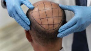 Wie lange hält eine Haartransplantation?