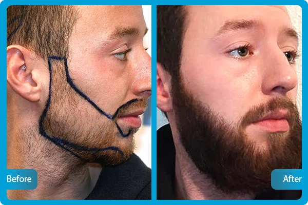 Bart Transplantation Türkei Vorher Nachher