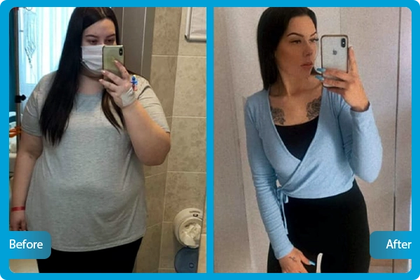 gastric-sleeve-before-after-3